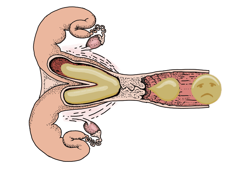 Gebärmuttererkrankungen bei Kühen von Metritis bis Pyometra: Symptome, Ursachen, Diagnostik und Folgen für Zyklus und Fruchtbarkeit.